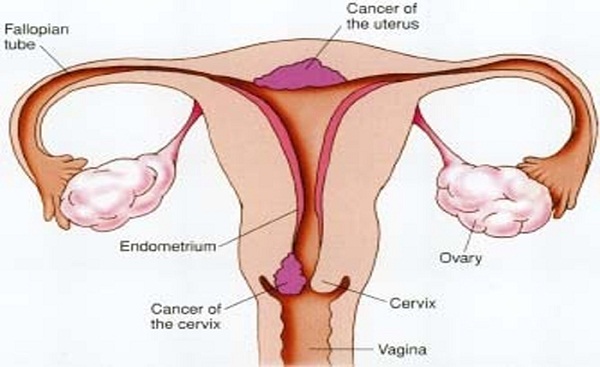 Cervical Cancer – Stages, Treatment and Prevention