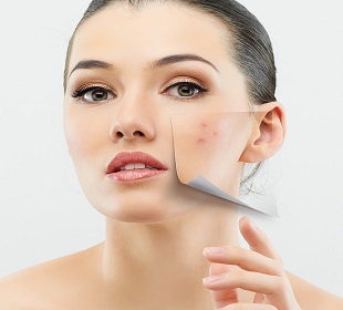 Dealing with Acne during Pregnancy
