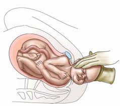 What is the Need for an Epidural