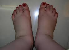 The Reason behind Ankle Swelling during Pregnancy